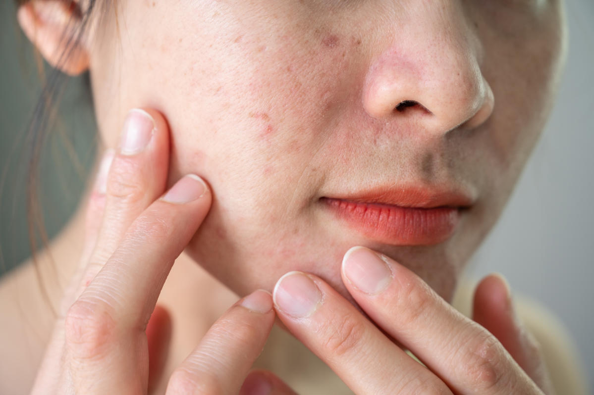 J'ai tenté d'éclater un bouton sur mon visage, c'était en réalité ...