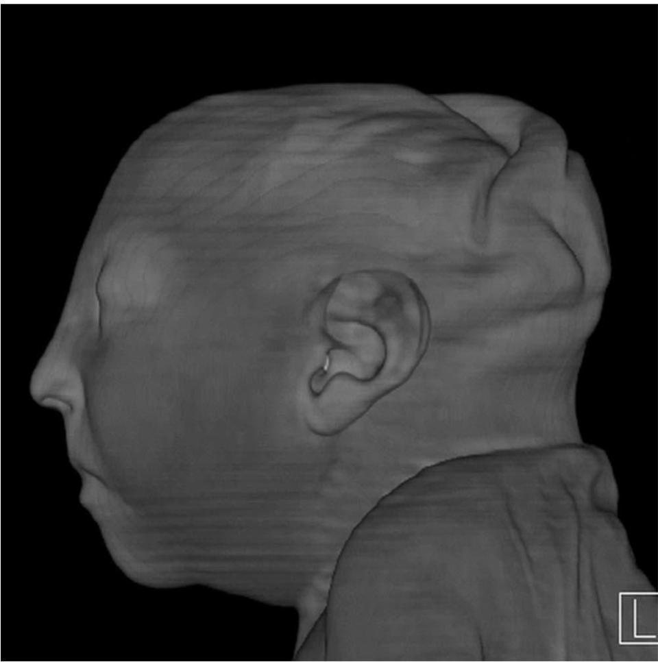 zika brain after birth