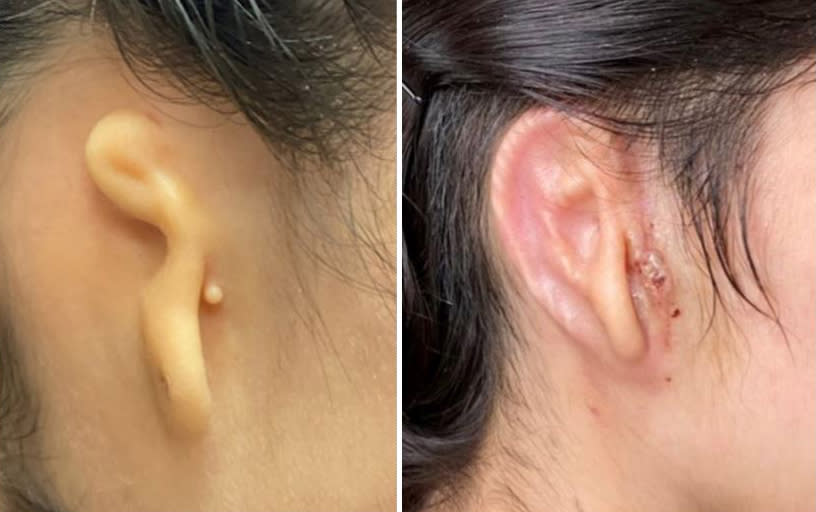 Patient's ear before surgery, left, and patient's ear 30 days post surgery.   (Courtesy Dr. Arturo Bonilla / Congenital Ear Institute)
