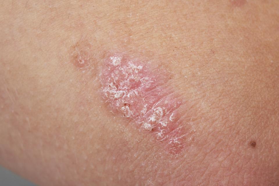 Psoriasis auf der Haut einer Frau