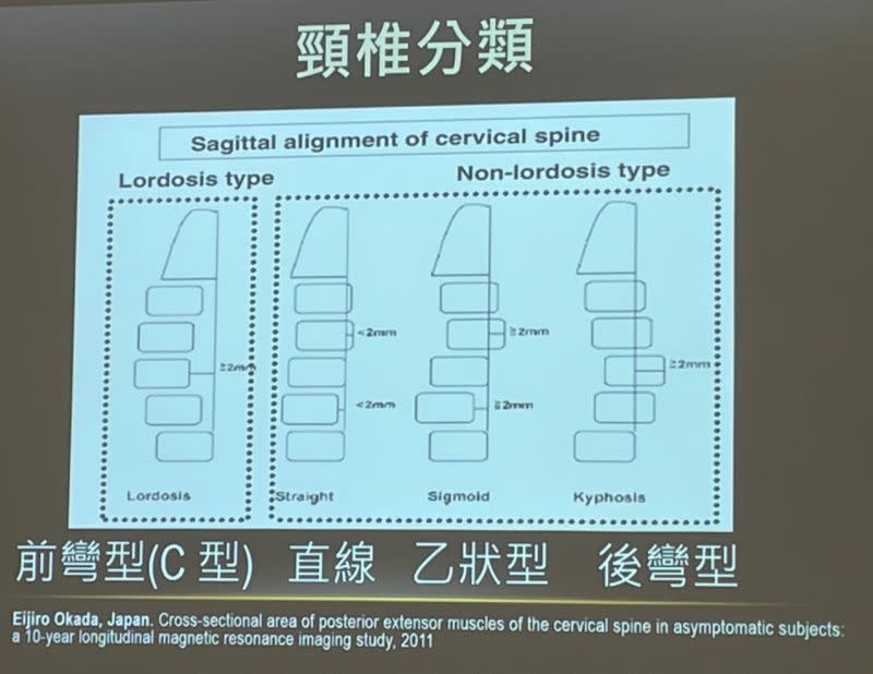 ▲奇美醫學中心麻醉部部長陳貞吟指出，頸椎過直(圖中直線型)，萬一受到撞擊或拉傷引起神經痛，較不易痊癒（圖／記者林怡孜攝，2022,12,06）