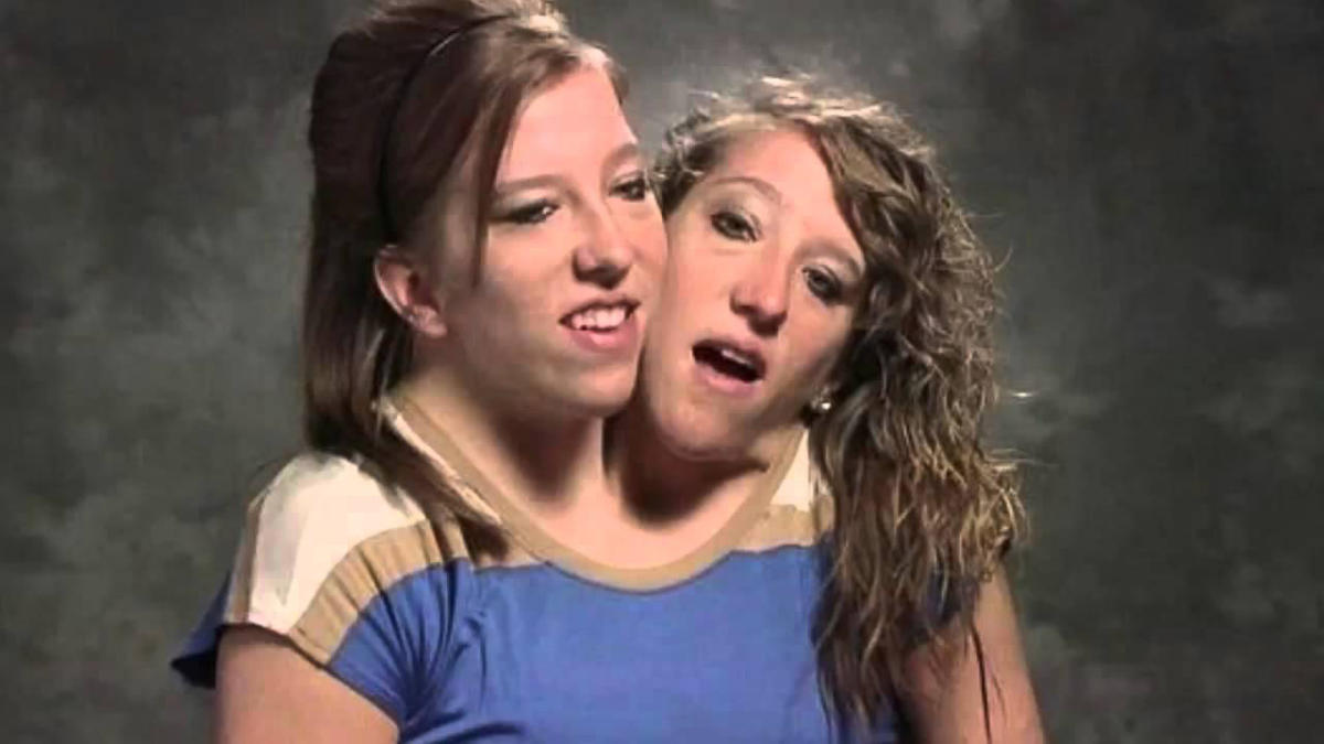 Conjoined Twins Abby and Brittany Hensel Live a LowProfile Life Today