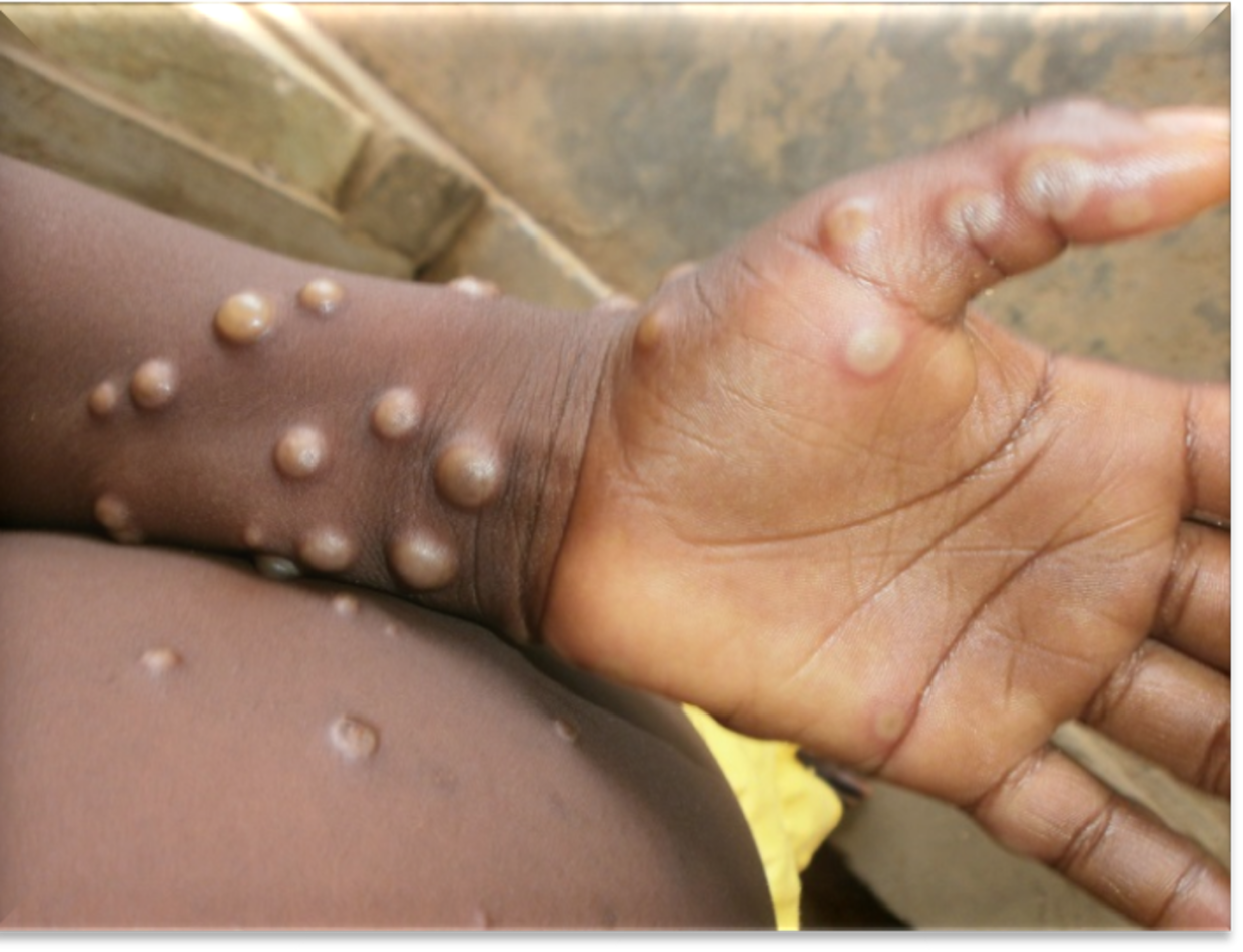 <span class="caption">Paciente infectado por el virus de la viruela del simio.</span> <span class="attribution"><a class="link " href="https://www.who.int/health-topics/monkeypox#tab=tab_1" rel="nofollow noopener" target="_blank" data-ylk="slk:OMS;elm:context_link;itc:0;sec:content-canvas">OMS</a></span>