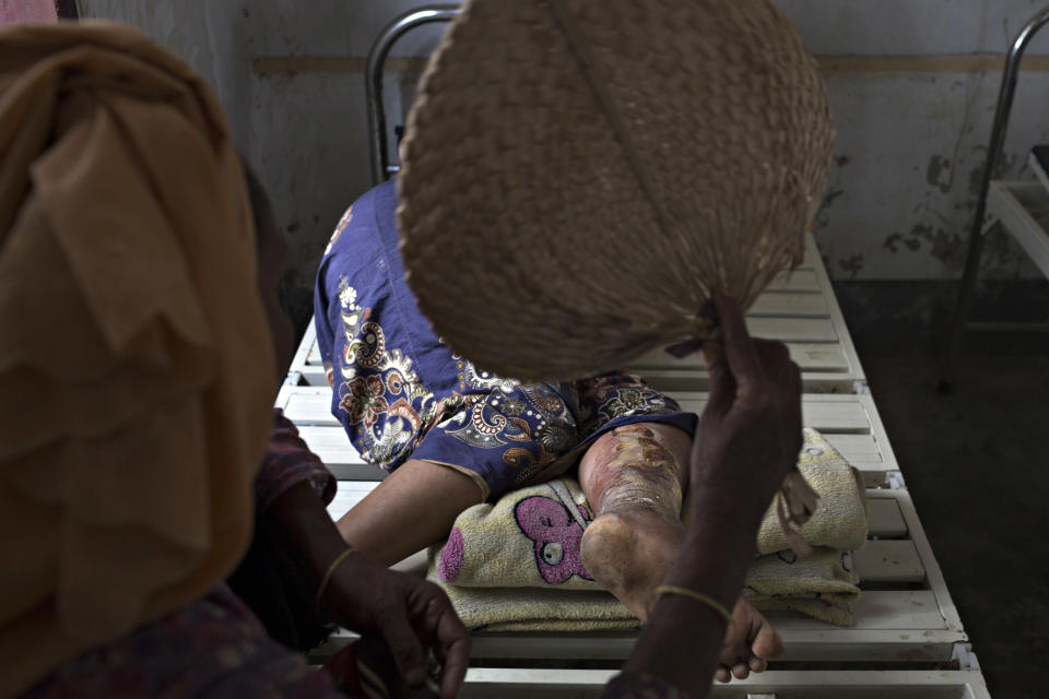 SITTWE, BURMA - MAY 06: Amina Kerto, 27, lays in a clinic in the Dar Paing refugee camp suffering from a fever resulting from an infected leg on May 6, 2014 in Sittwe, Burma. Some 150,000 Rohingya IDP (internally displaced people) are currently imprisoned in refugee camps outside of Sittwe in Rakhine State in Western Myanmar. Medecins Sans Frontieres (MSF), the primary supplier of medical care within the camps, was banned in March by the Myanmar government. Follow up attacks by Buddhist mobs on the homes of aid workers in Sittwe put an end to NGO operations in the camps. Though some NGOs are beginning to resume work, MSF remains banned, and little to no healthcare is being provided to most Rohingya IDPs. One Rohingya doctor is servicing 150,000 refugees with limited medication. Several Rakhine volunteer doctors sporadically enter the camps for two hours a day. Births are the most complicated procedures successfully carried out in the camps, requests to visit Yangon or Sittwe hospitals for life threatening situations require lengthy applications and are routinely denied. Malnutrition and diarrhea are the most widespread issues, but more serious diseases like tuberculosis are going untreated and could lead to the rise of drug resistant tuberculosis (DR-TB).  (Photo by Andre Malerba/Getty Images)