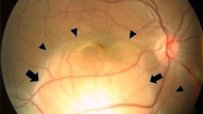  Close-up retinal image of the patient's eye. Red blood vessels can be seen branching from a focal point in the mid-right-hand-side of the image. Black arrows point to the cancerous lesion and retinal detachment. The image of the eye is a circle shape and the eye appears to be a yellow color. There is a black background. 