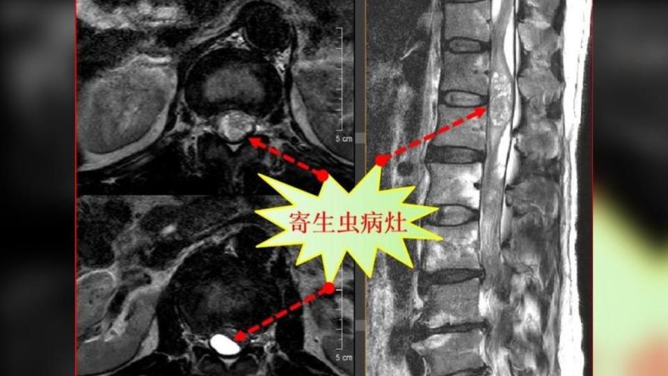 郭先生的脊髓中發現多處寄生蟲病灶。 （圖／翻攝自羊城晚報）