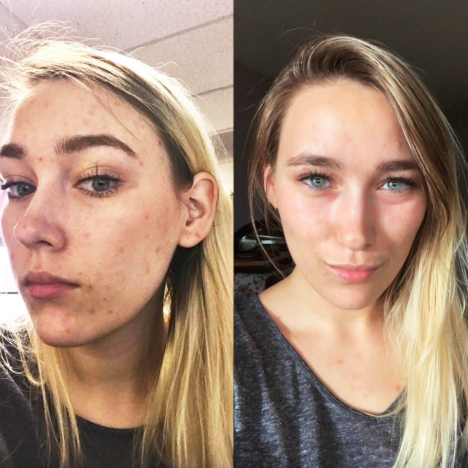 The Exact Products That Finally Cleared This Woman S 10 Year Long Struggle With Acne