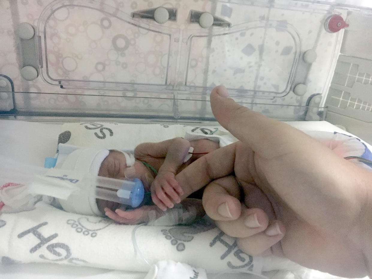 Baby Lorcan weighed just 1lb 9oz when he was born [Photo: Caters]