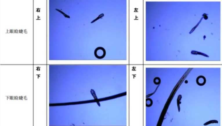 患者眼睫毛藏有大量蟎蟲。（圖／翻攝自羊城晚報，下同）