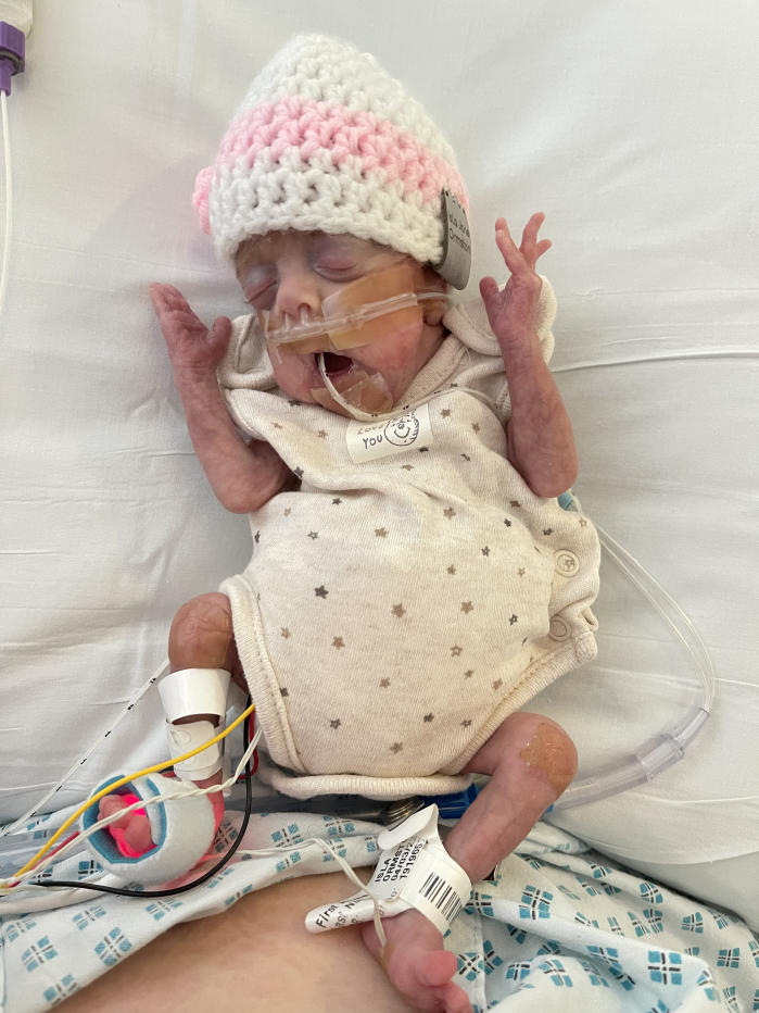 Doctors gave baby Isla just a 10% chance of survival. (Lauren Ormston/SWNS)