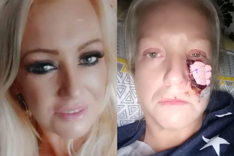 Kelly Allen, 45, from Swansea, had part of her cheek ripped off when she was attacked without warning by a friend's pet dachshund