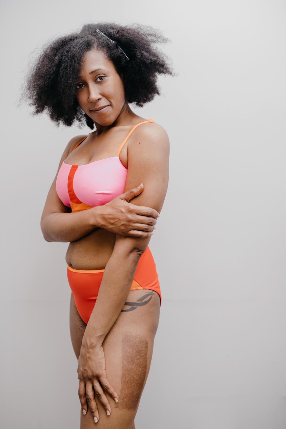 Miga Swimwear wants to change the way we think about disfigurement by creating one-pieces and bikinis designed with that in mind.