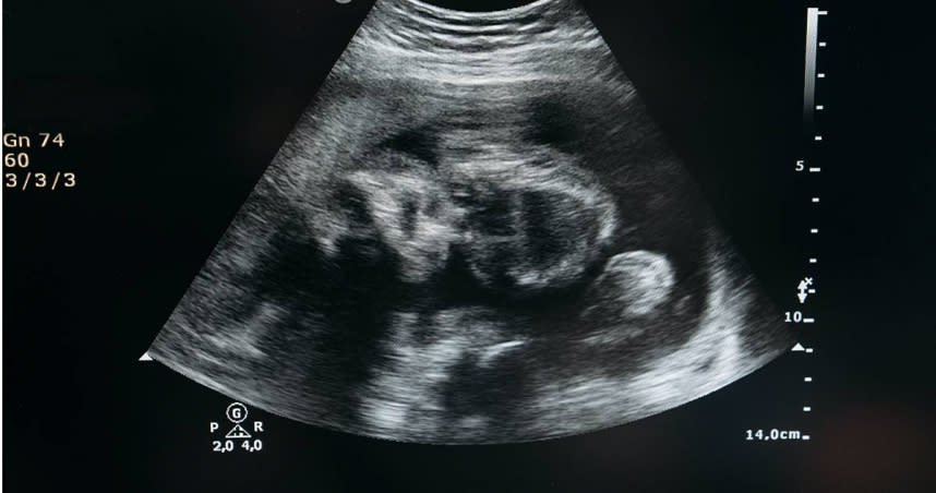 一名裝有避孕器10年的女子，因肚子痛就醫後驚知已懷孕5個月。（示意圖／Pexels）