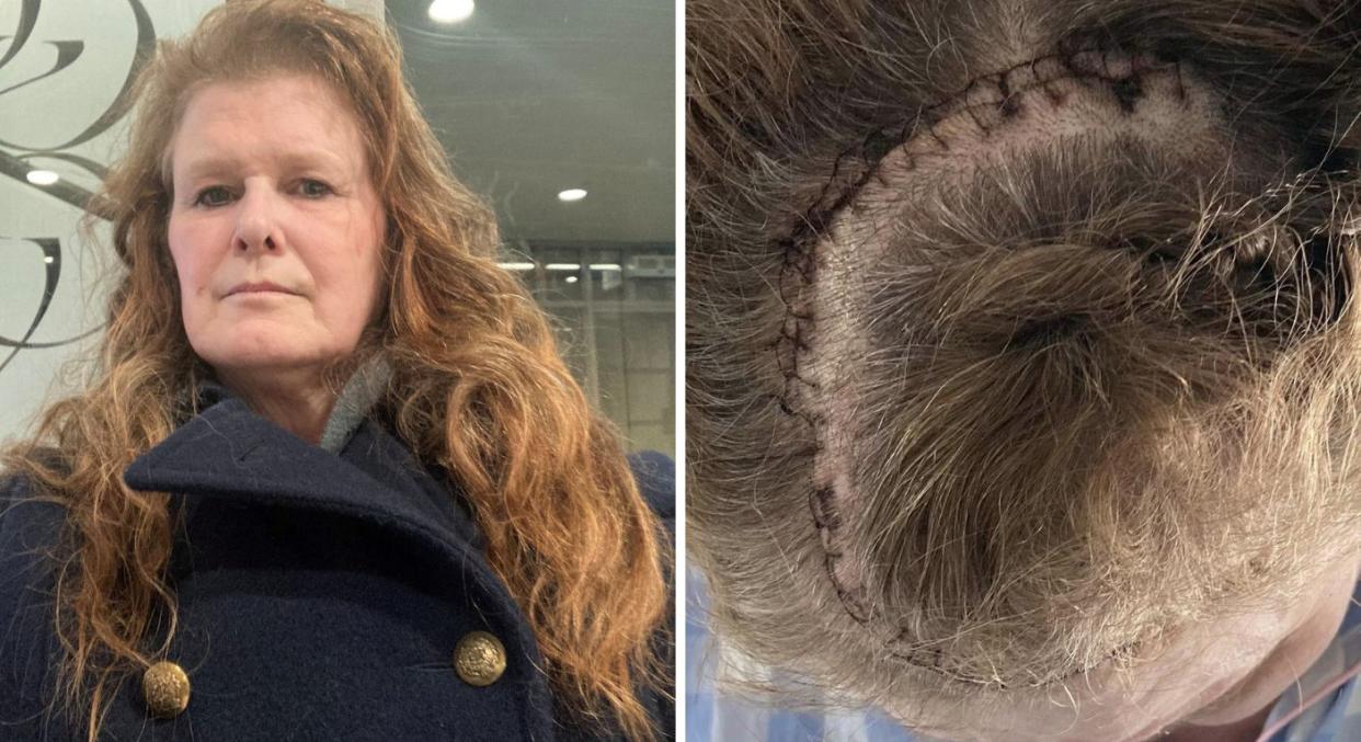 Helen Green thought her seizures were due to stress but discovered she had a tennis-ball-sized brain tumour. (Helen Green/SWNS)