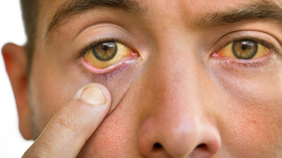 Close up of a young man's eyes. He is using his forefinger to pull down his right bottom eyelid to show off how yellow his whole eyes are.