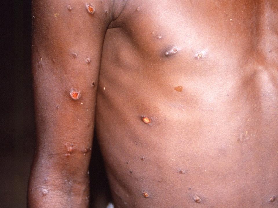 Monkeypox was first detected in the Democratic Republic of the Congo in 1970 (Reuters)