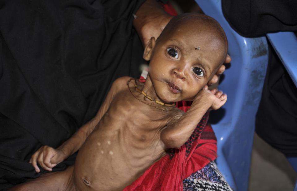 In this photo taken Saturday, Feb. 25, 2017, malnourished baby Ali Hassan, 9-months-old, is held by his mother Fadumo Abdi Ibrahim, who fled the drought in southern Somalia, at a feeding center in a camp in Mogadishu, Somalia. Thousands of desperate people are streaming into Somalia's capital seeking food as a result a prolonged drought, overwhelming local and international aid agencies, while the Somali government warns of a looming famine, compounded by the country's ongoing conflict against Islamic extremists. (AP Photo/Farah Abdi Warsameh)