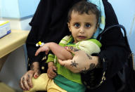 <p>A cholera-infected Yemeni child receives treatment at a hospital in Sanaa, Yemen, 08 May 2017. According to the World Health Organization, a total of 25 Yemenis have died from cholera over the past few days, while 1,350 suspected cases have been reported in the capital Sana?a and several provinces of the conflict-plagued Arab country. (Yahya Arhab/EPA) </p>