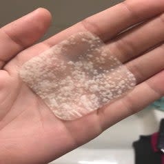 Reviewer photo of square acne patch that is filled with pimple discharge