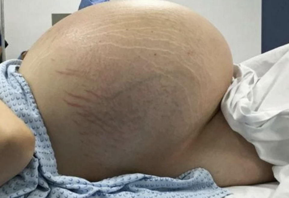 A patient lying on a bed with an enormously distended abdomen with stretch marks and veins visible