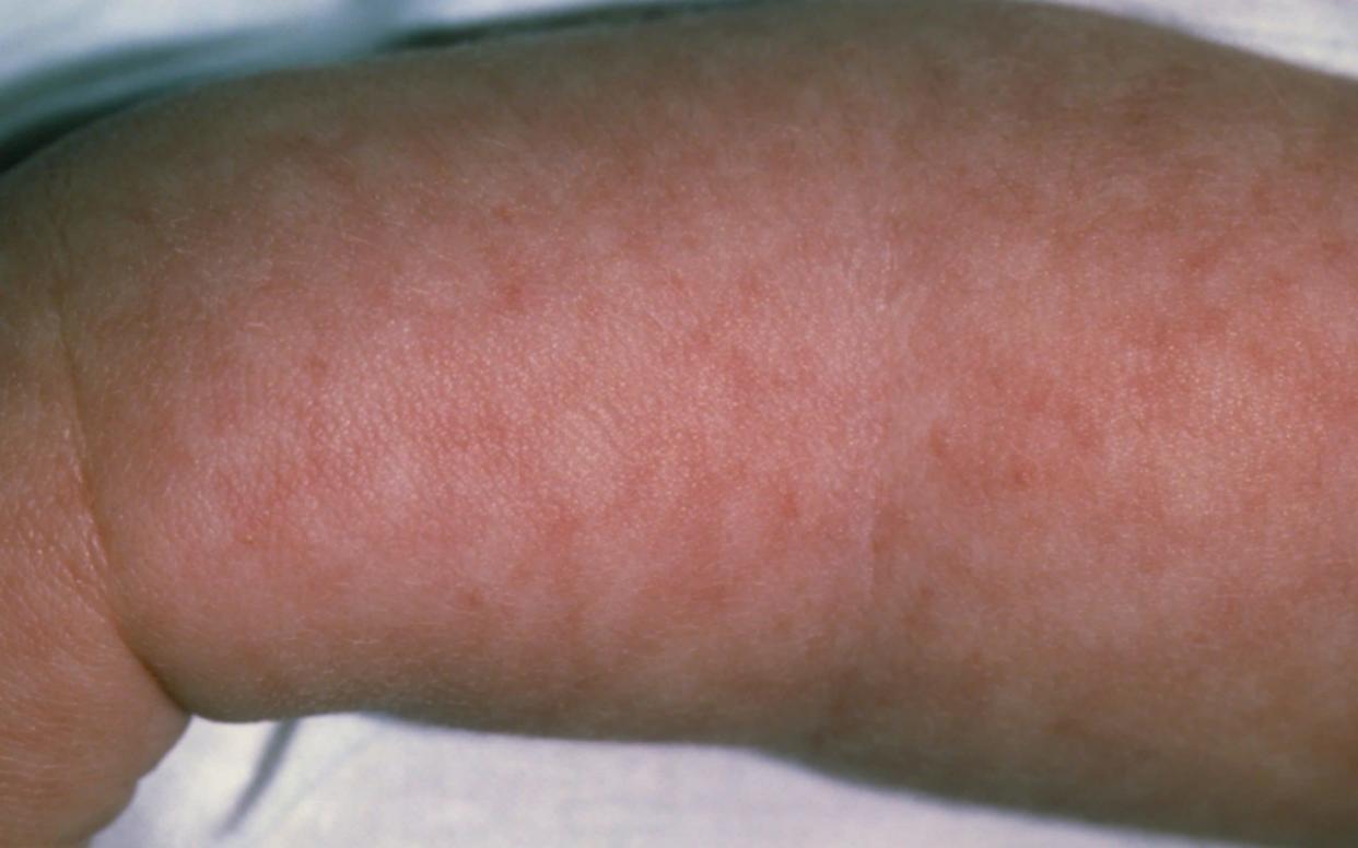 A baby's arm showing a rash from viral meningitis - Science Photo Library RM