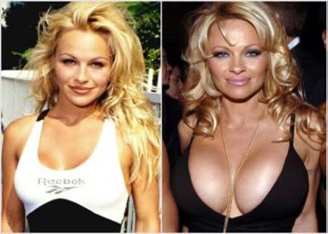 Did She or Didn't She? Telltale Signs of Bad Plastic Surgery
