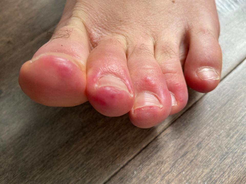 dr ilan schwartz covid toes photo