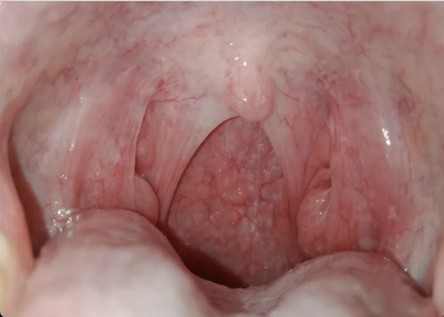 normal throat bumps