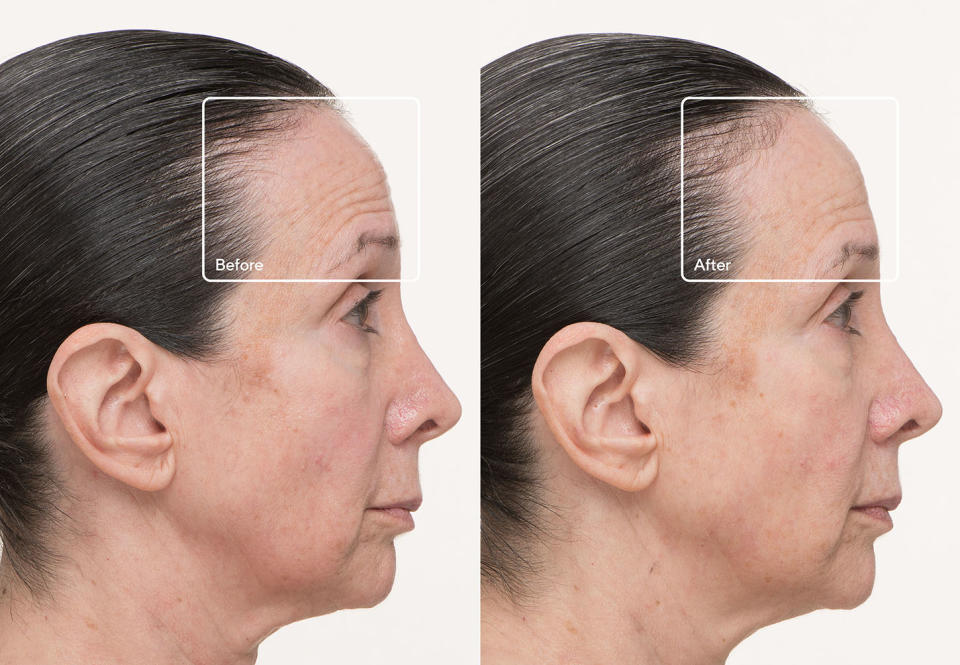 Before and after 12 weeks of use with the TheraFace LED face mask. Photo: Supplied