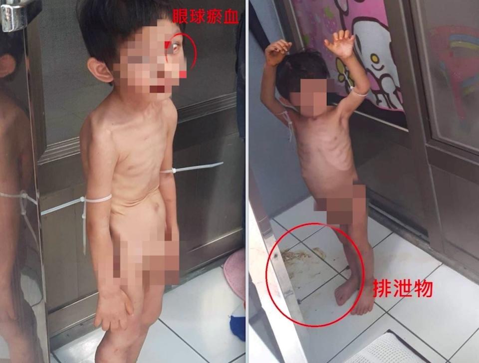 3歲男童骨瘦如柴，全身沒穿衣服被用束帶綁手關在屋外陽台。