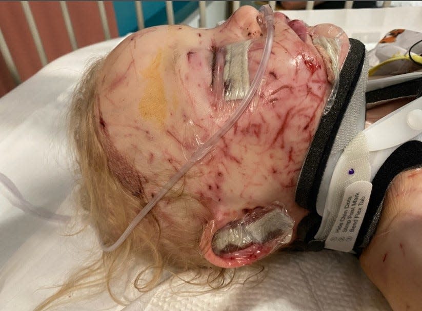 Felicity Peden, 2, suffered injuries after being attacked by her family's four puppies on June 3, 2022 in California. The girl underwent three hours of plastic surgery and was recovering Wednesday, June 15, 2022.