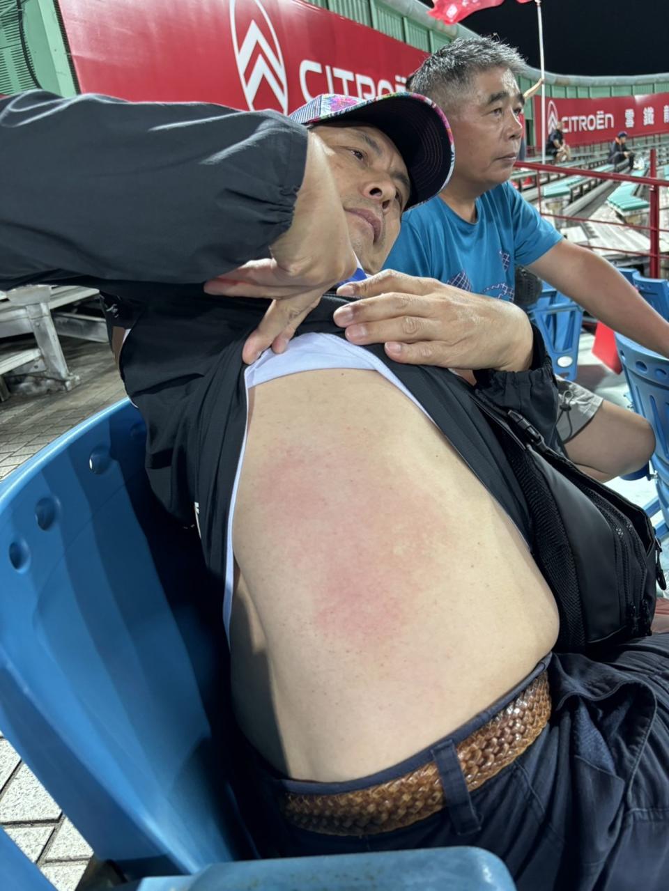蘇炳憲分享身上被棒球砸傷的瘀青。（民視提供）