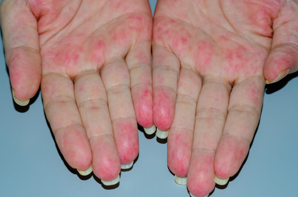 A patient featuring inflammation of the blood vessels in her hands, this is the condition Ashton Kutcher has