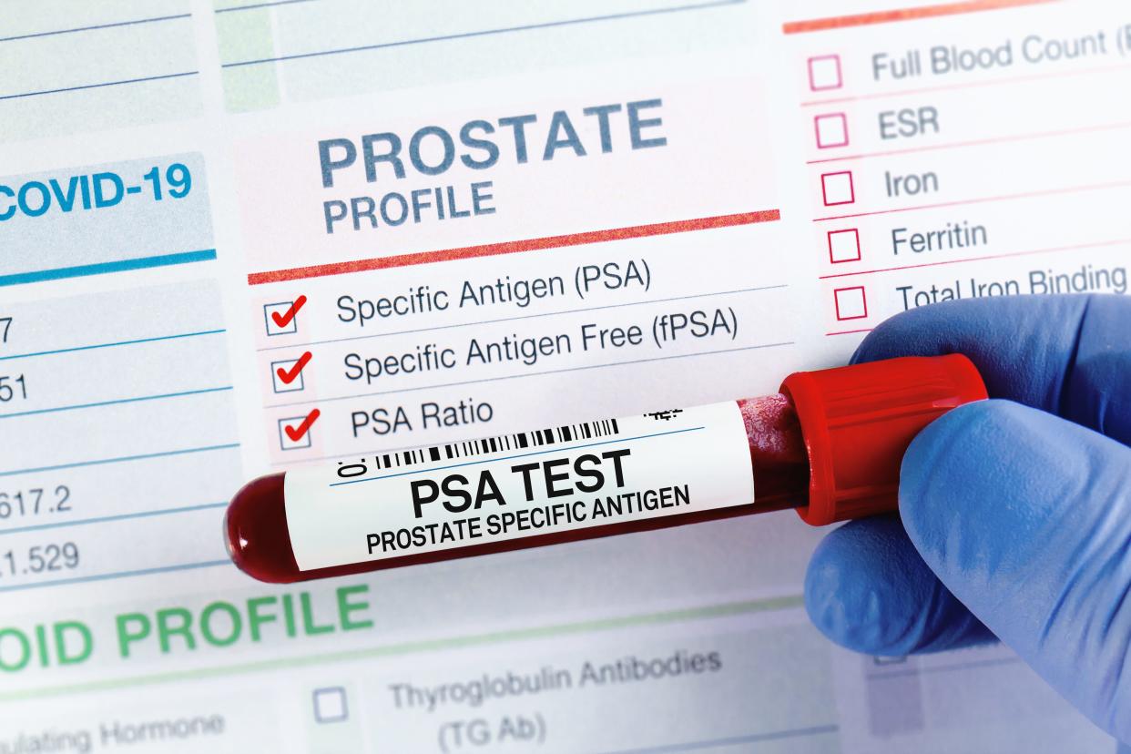 Photo illustration of test tube with requisition form for PSA Prostate Specific Antigen test.