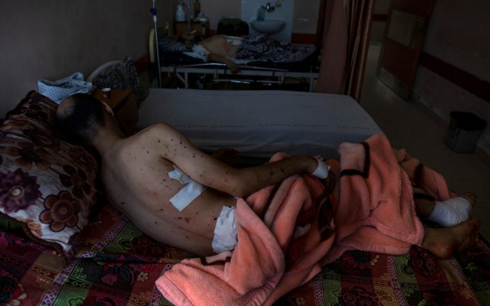 Sharif Al-zaharna, 33, rests at the Shifa hospital in Gaza City, Thursday, May 13, 2021, where he is receiving treatment for wounds caused by a May 10 Israeli strike that hit a nearby his family house in town of Jabaliya - AP