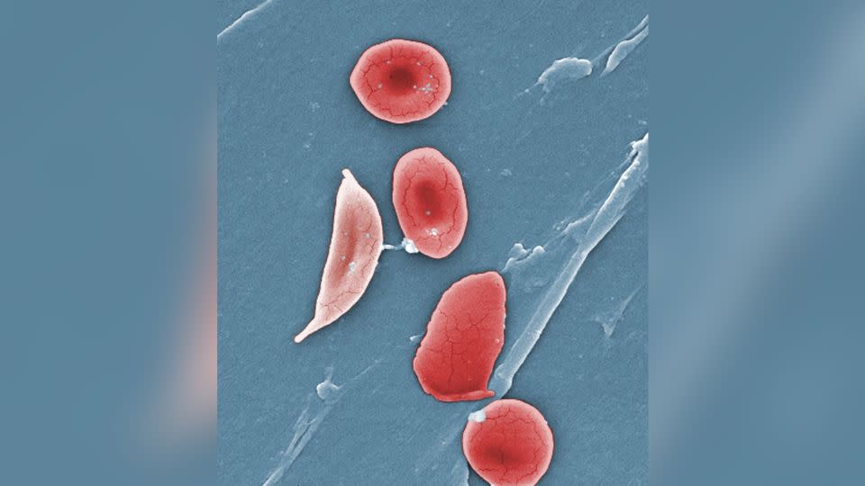 This microscope image shows a sickle cell (left) and normal red blood cells of a patient with sickle cell anemia. Over 100 million people suffer from the disease, a large majority of them having African ancestry. (Janice Haney Carr/CDC/Sickle Cell Foundation of Georgia via AP) - Janice Haney Carr/AP