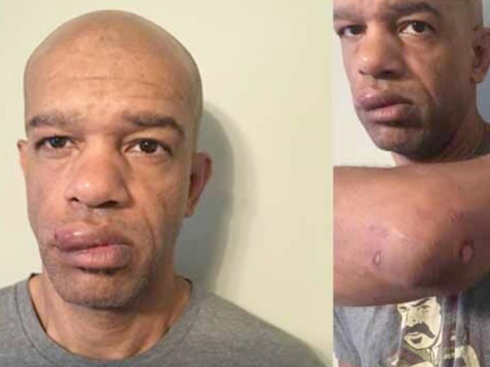 Former St. Louis police officer Luther Hall is pictured here with injuries he received when colleagues beat him during a protest in 2017 (Trial photos)