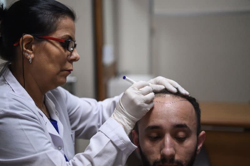 El pelo que se implanta se cae alrededor de 15 días después, al mes empieza a nacer en la zona trasplantada, creciendo al ritmo de un centímetro mensual. (Foto: AFP Photo/Ozan Kose)