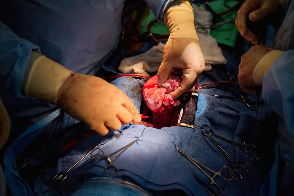 During a transplant procedure performed last week at NYU Langone, putting a gene-edited pig heart into a recently deceased person.