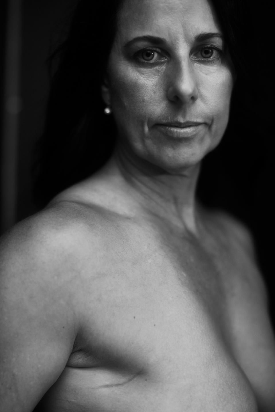 Felicity Parker embraces the scar, under her arm, from breast cancer. (Photo: Courtesy of Project WomanKIND)