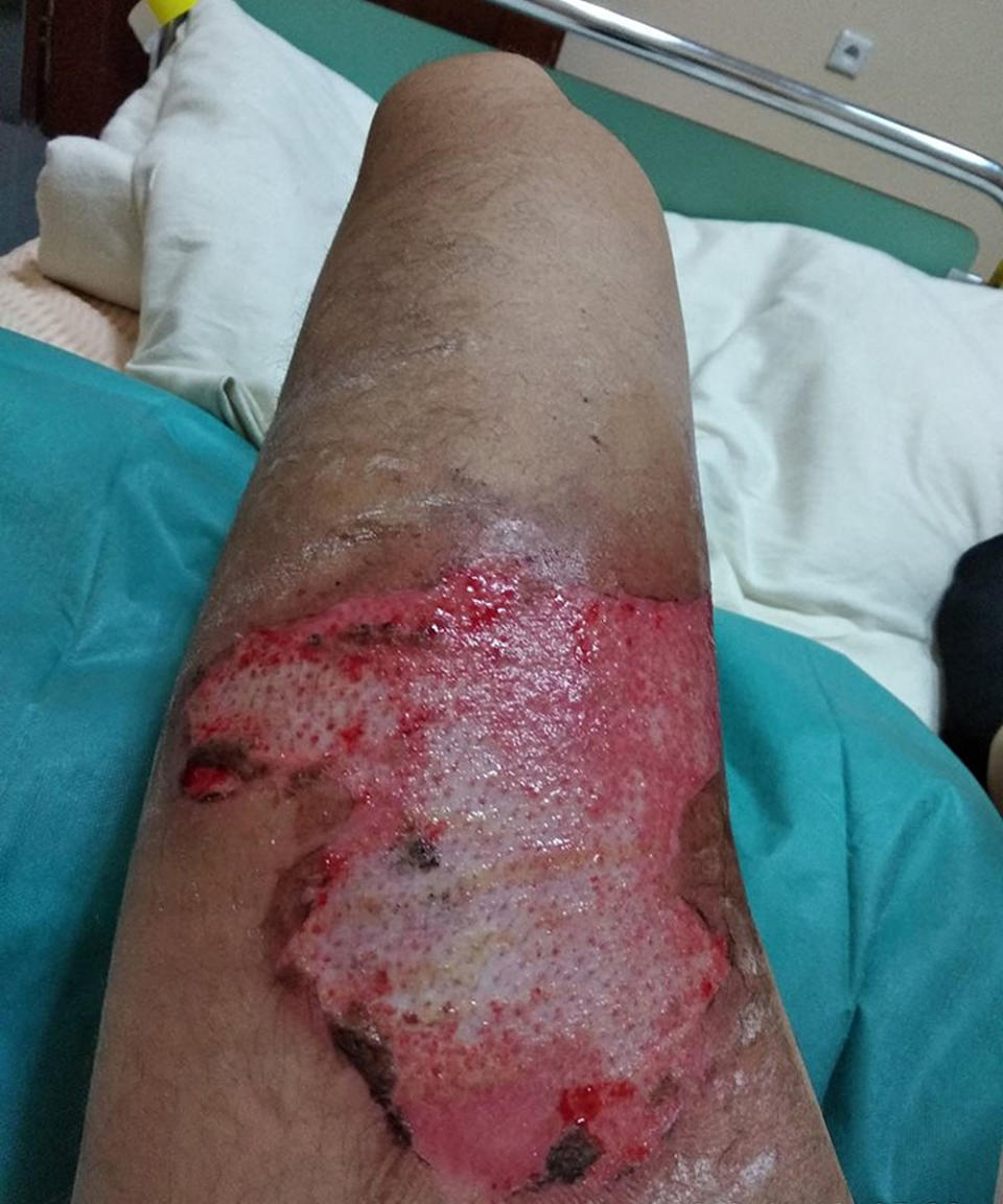 Damian received third-degree burns and needed a right leg skin graft. Source: CEN/ Australscope