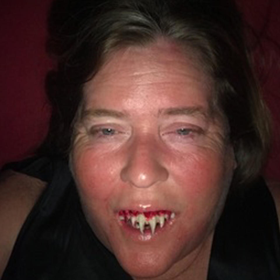 Ms Tew was left sporting the fake teeth long after her Halloween party was over. Source: WKRG