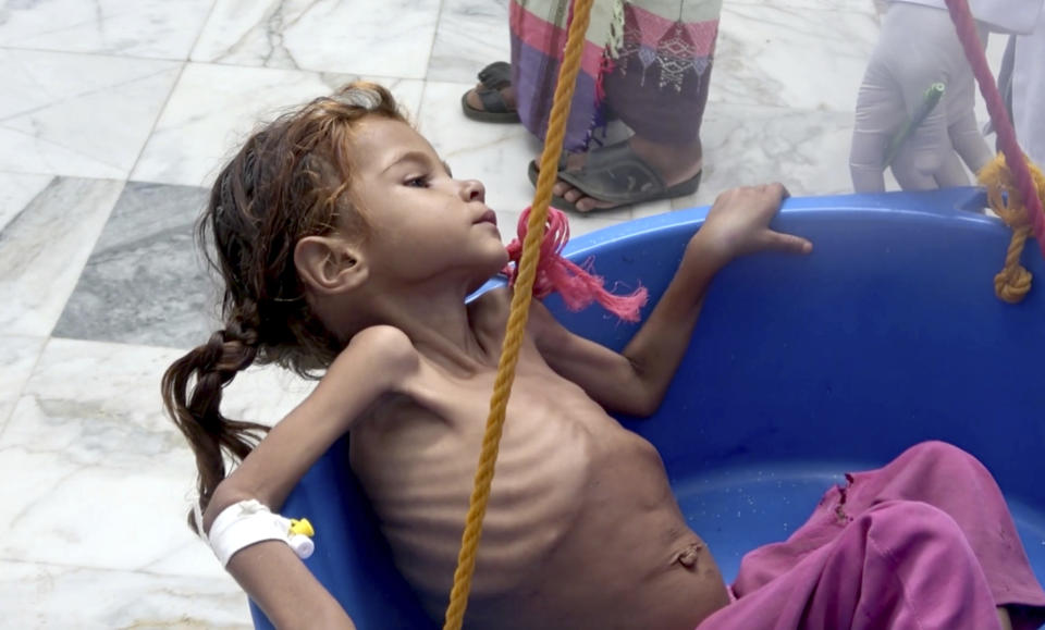 In this Aug. 25, 2018 image made from video, a severely malnourished girl is weighed at the Aslam Health Center in Hajjah, Yemen. Around 2.9 million women and children are acutely malnourished; another 400,000 children are fighting for their lives. Yemen’s civil war has wrecked the impoverished country’s already fragile ability to feed its population. (AP Photo/Hammadi Issa)