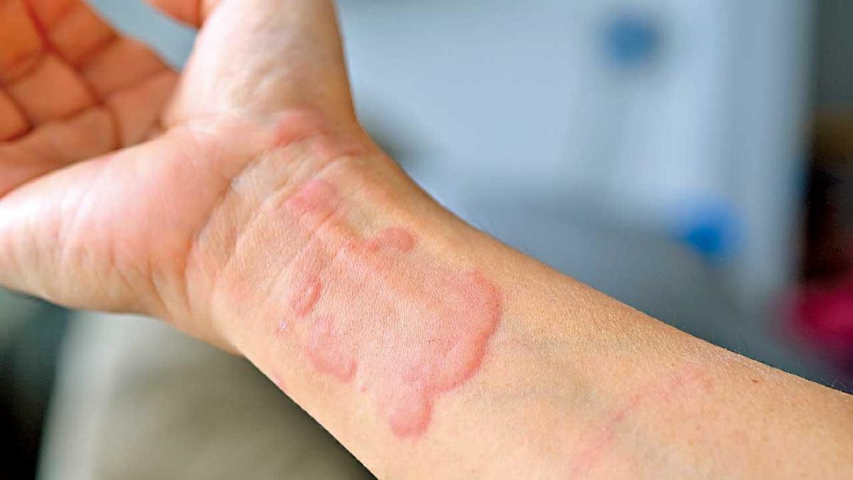 Understanding Urticaria: Symptoms, Causes, and Treatment Options