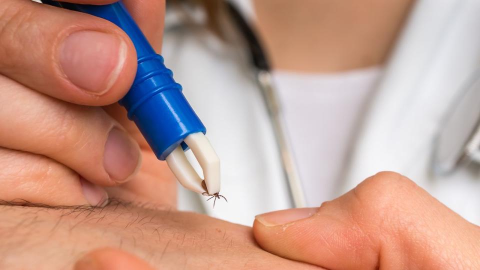 Wurden Sie von einer Zecke gestochen, dann verwenden Sie am besten immer eine Zeckenzange. Finger weg von Hausmittelchen wie Öl oder gar Nagellack. (Bild: iStock / andriano_cz)