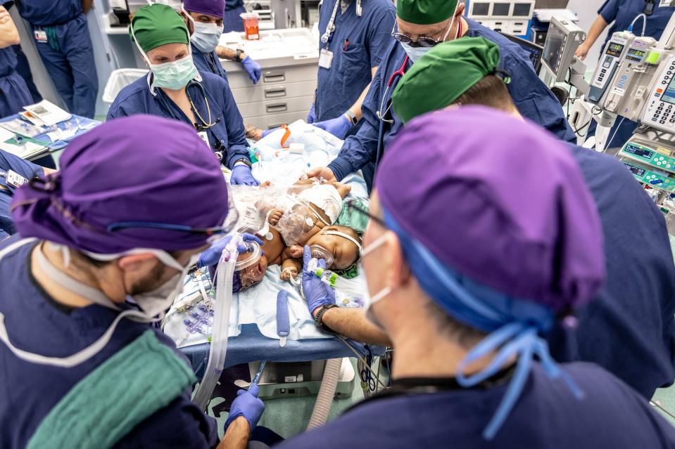 JamieLynn and AmieLynn, Conjoined Twin Girls Separated at Cook Children’s Medical Center Make History