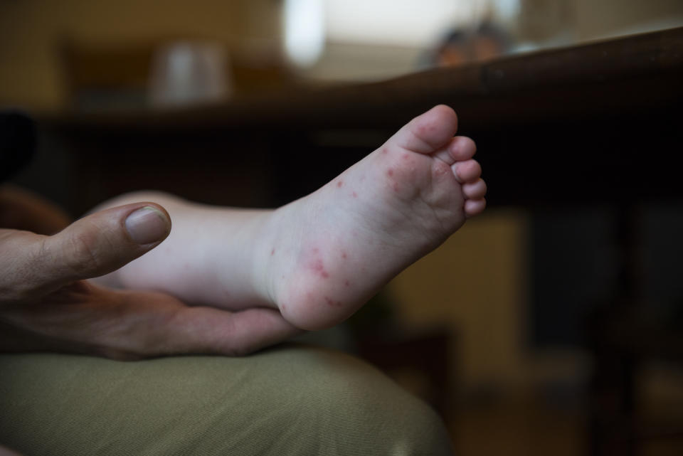 Hand-foot-and-mouth disease (HFMD) presents a rash that sometimes blisters on the palms of hands, the soles of feet, and other areas of the body such as elbows and knees. Image via Getty Images.