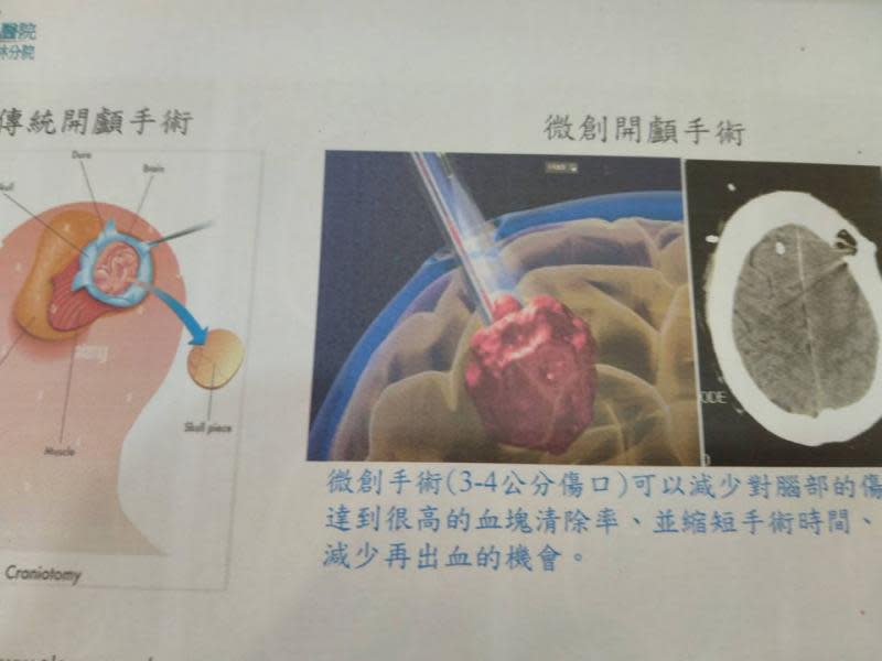 出血性腦中風微創手術　縱觀古今後的未來性