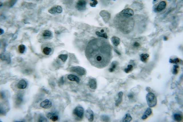 <p>Getty</p> Naegleria fowleri, known as the brain-eating amoeba.