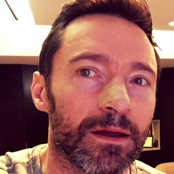 Just hours earlier he'd had 80 stitches in his nose after having a cancerous mole removed and was told not to sing, pictured here following the surgery in 2016. Source: Instagram/HughJackman